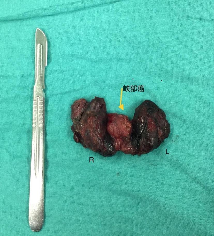 峡部为主的多灶性乳头甲状腺癌表现为包括vii区的中央区淋巴结明显