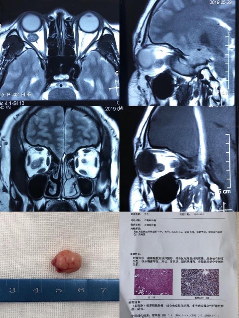 眼眶梭形细胞肿瘤一例