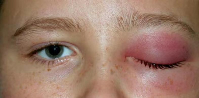 具有红痛的眼睑肿块的疾病鉴别