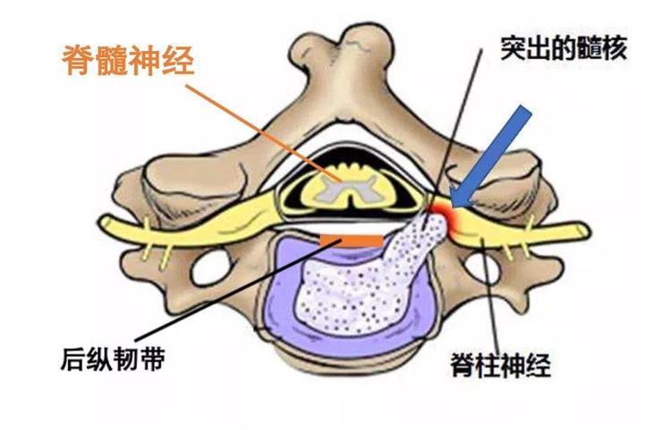 首先,我们来谈谈它基本的病因,我们颈椎的重要神经有脊髓神经(中枢
