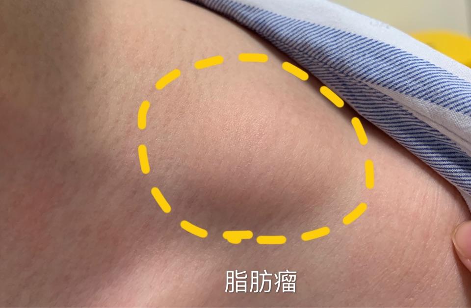 脂肪瘤 - 微医(挂号网)