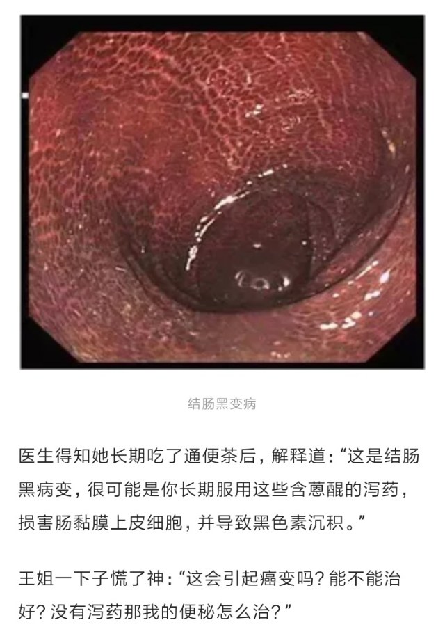 拿到肠镜报告她吓了一跳这就是传说中的黑心肠吗