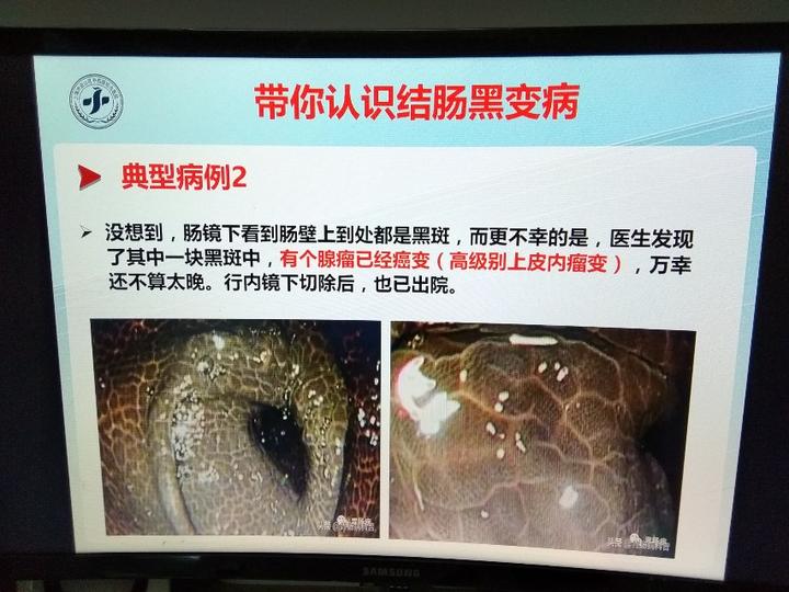 带你认识结肠黑变病的临床表现及治疗上
