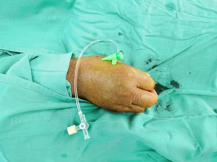 桡动脉穿刺置管右侧椎动脉狭窄球囊扩张支架植入术_赵开军医生文章