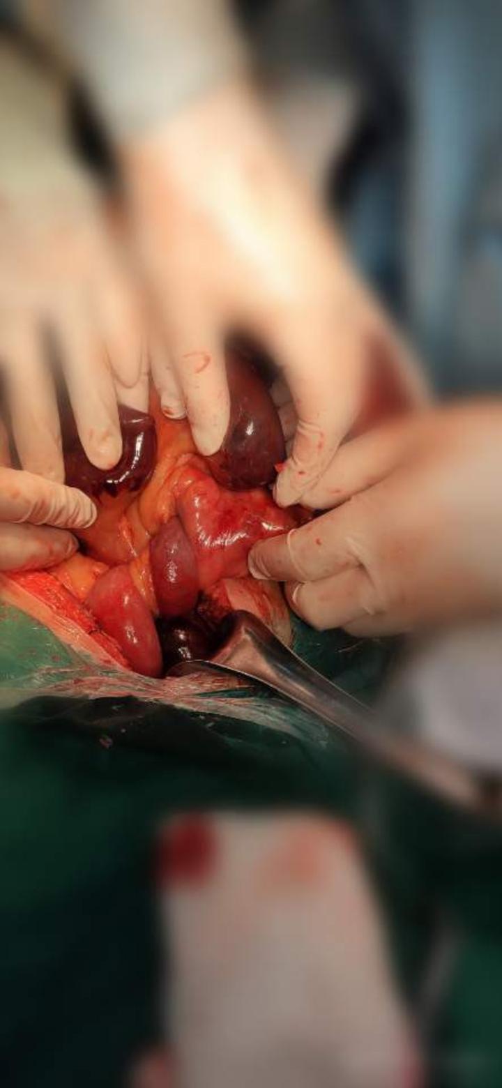 都坏死了,仅有不到100cm的小肠是正常的,只能将大部分小肠切除了,术后