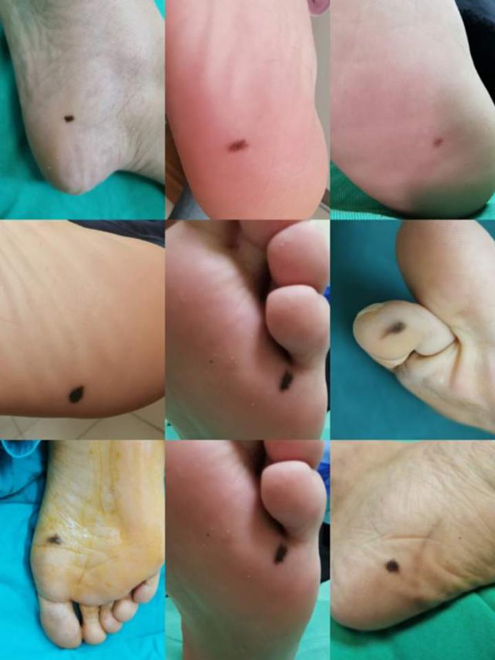 脚底痣要不要手术切除 - 微医(挂号网)