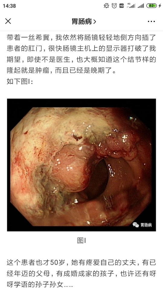 便血半年当痔疮查出肠癌太冤枉医生提醒这5个症状不是痔疮是肠癌