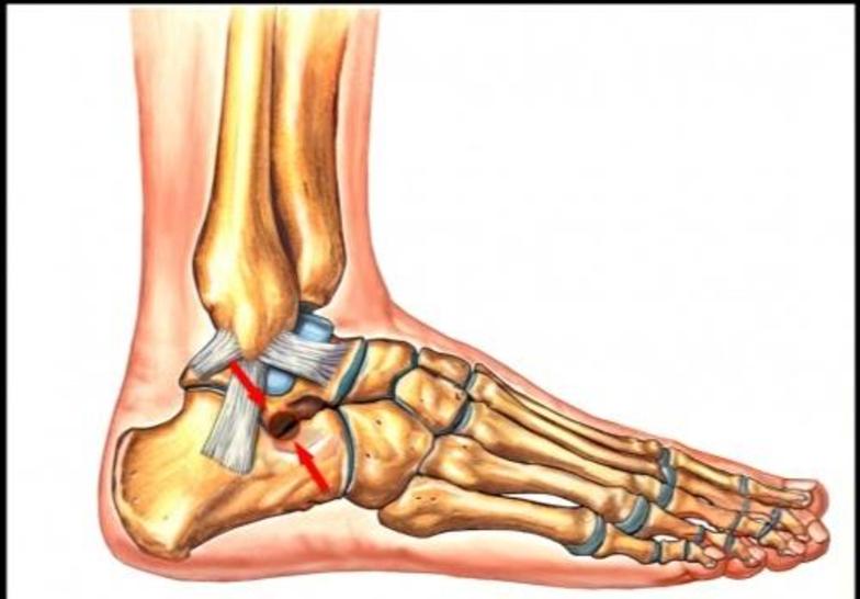 崴脚专业户注意!这个地方的深部疼痛,可能是"跗(fū)骨窦综合症"