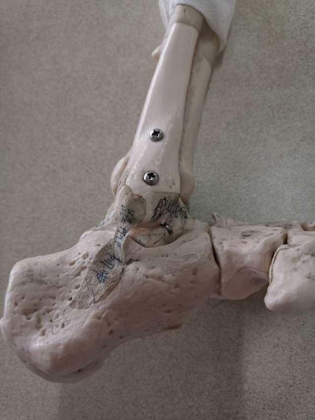 距腓前韧带是稳固足与踝 的一条重要韧带,一旦损伤,足踝部稳固性严重