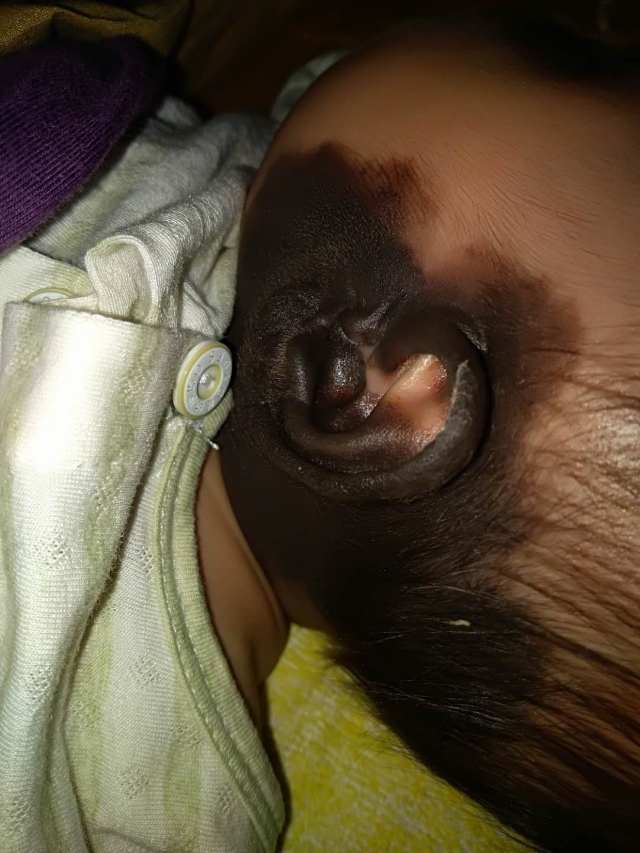 新生儿头部大面积黑毛痣