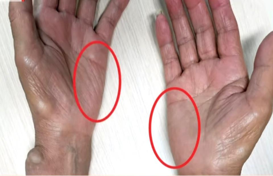 性疼痛,麻木,痛温觉减退甚至缺失,皮肤汗少干燥增厚,肌无力,肌萎缩等