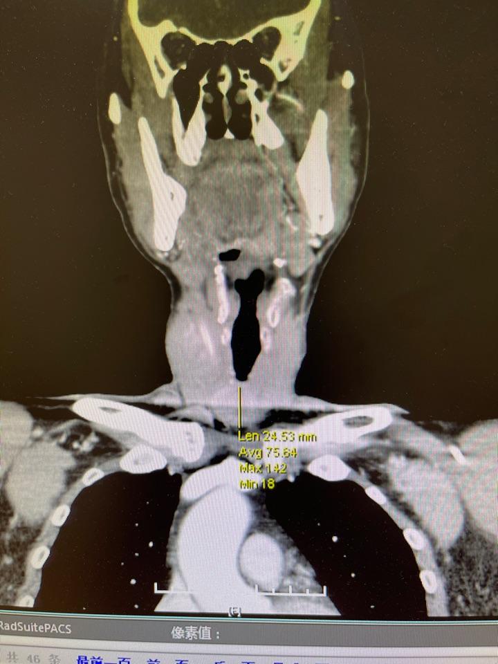 15月前颈部ct侧区复发淋巴结,侵犯同侧颈总动脉