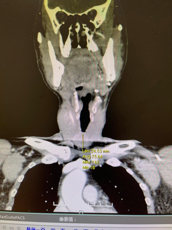 甲状腺癌ct表现图片
