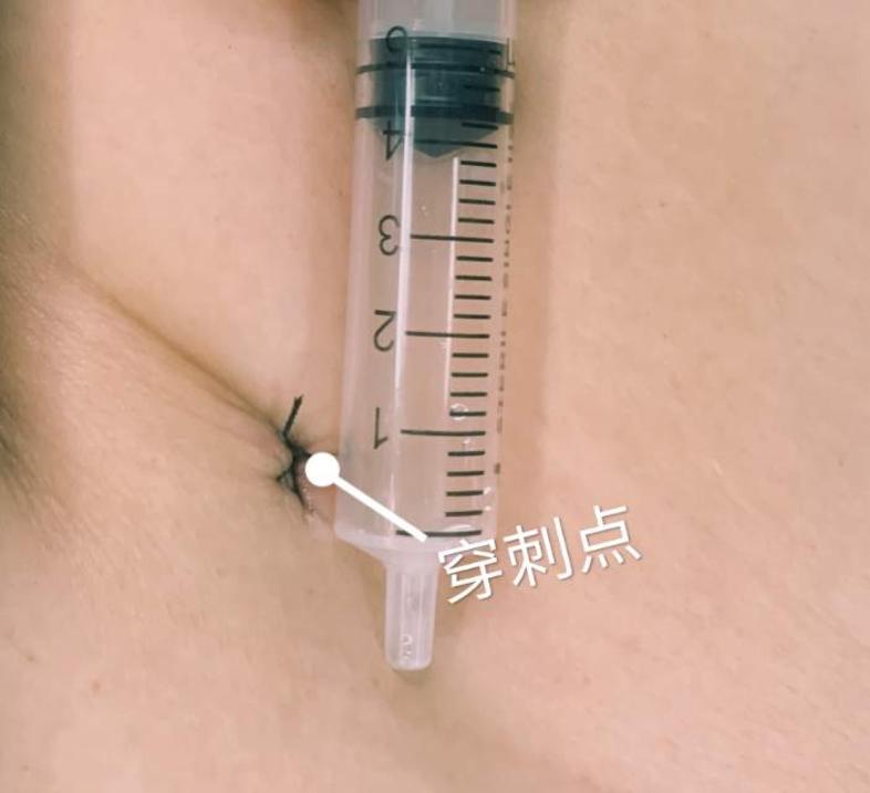雅培pfo封堵器25-18mm成功封堵未闭合卵圆孔术后超声探查封堵伞形态好