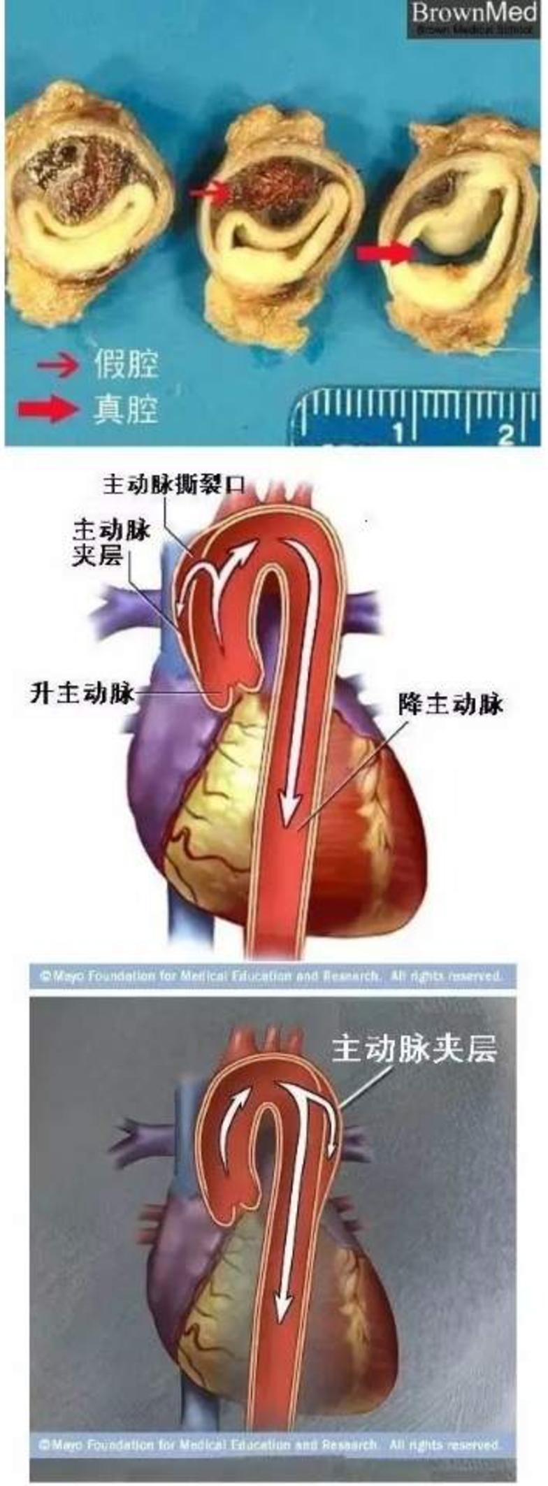动脉分层及夹层示意图血液由心脏泵出后经主动脉,分支动脉,中小动脉