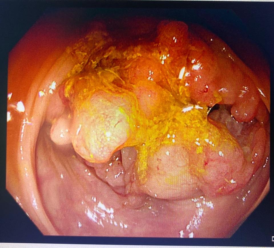 检查结果不容乐观,血常规提示中度贫血,肠镜提示结肠癌,癌块长在