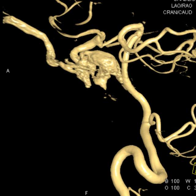 颈动脉海绵窦瘘图片图片