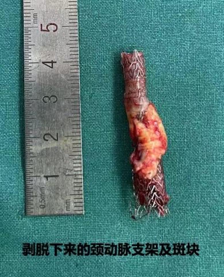 颈动脉斑块和支架长什么样