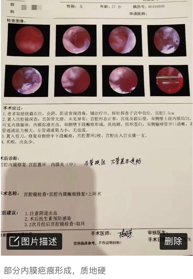 宫腔镜手术在生殖方面的优势二