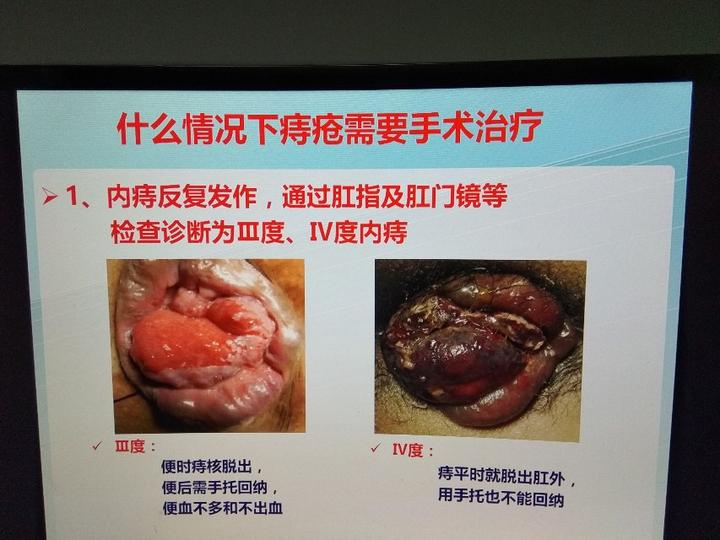 带你认识什么情况下痔疮需要手术治疗