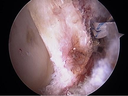 髋关节盂唇损伤髋关节镜治疗缓解