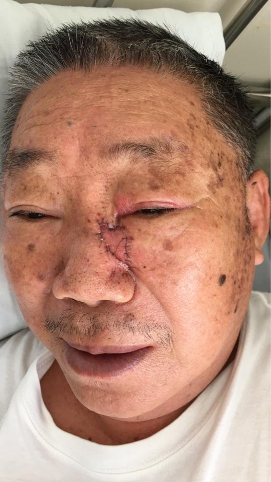 面部皮肤肿瘤风筝皮瓣修复 - 微医(挂号网)