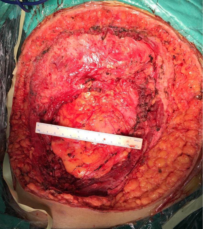 腹壁巨大肿瘤腹壁成功重建 - 微医(挂号网)