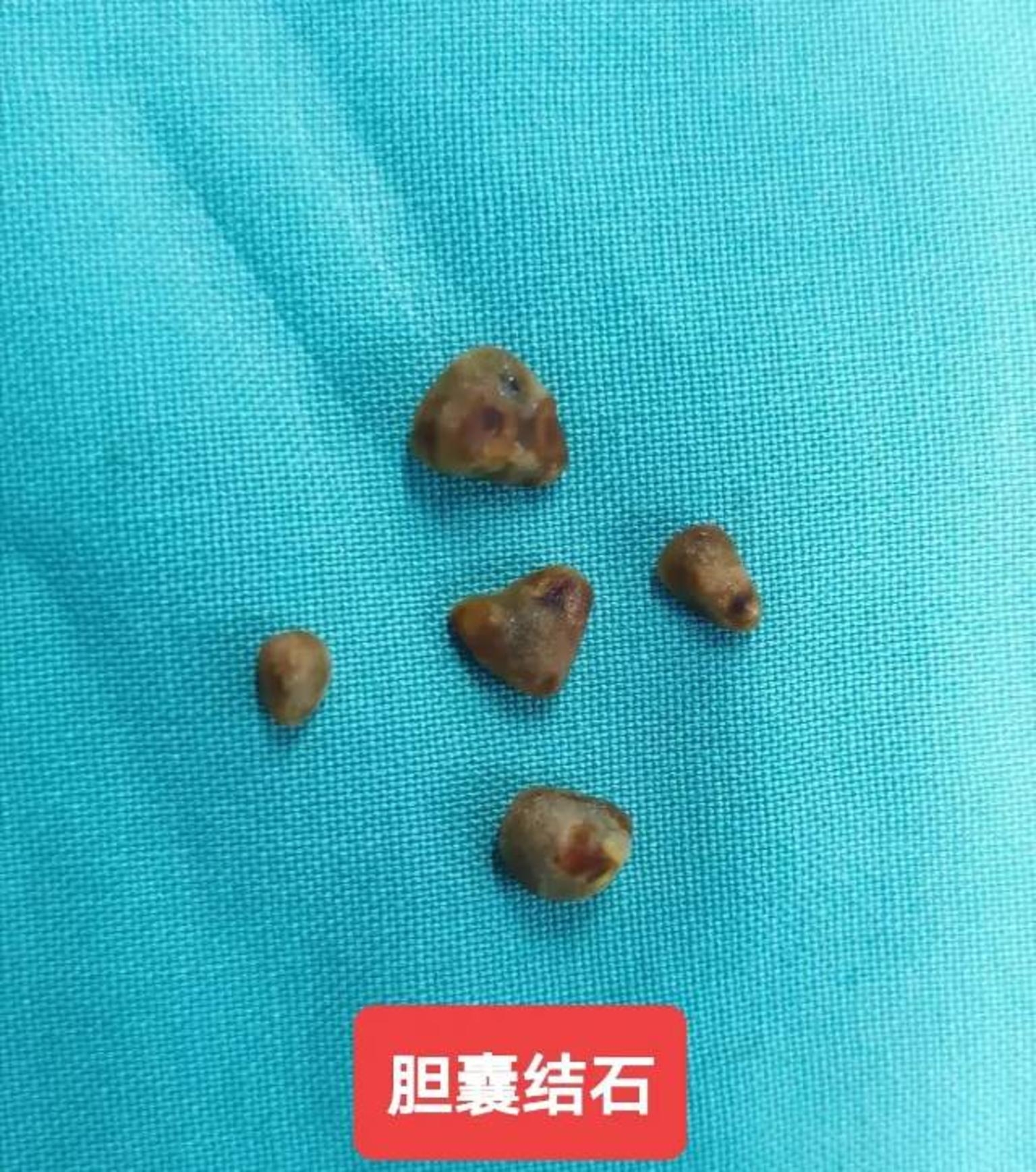 胆囊结石胆囊炎在没有症状或者有症状的早期阶段可以考虑保胆取石手术