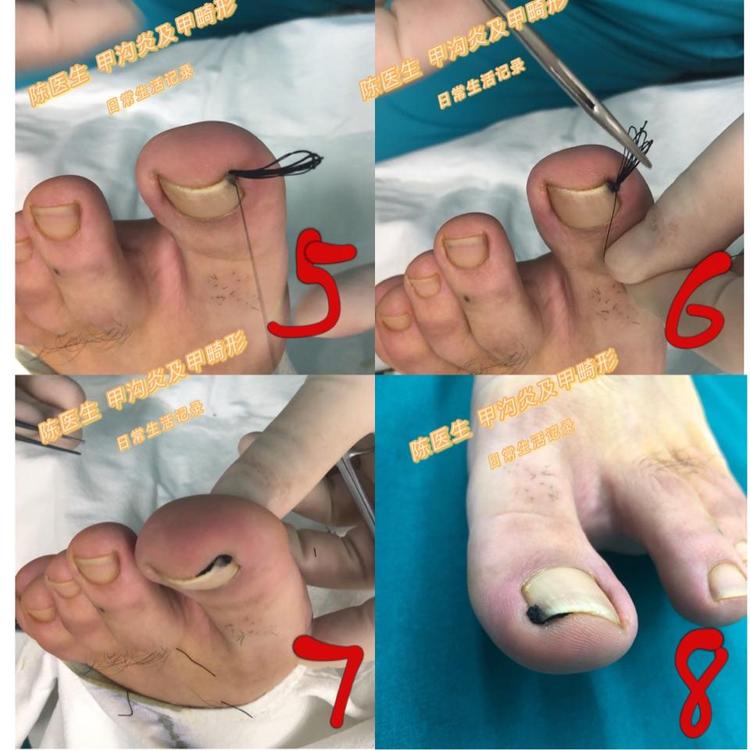 嵌甲的无创治疗挂线法