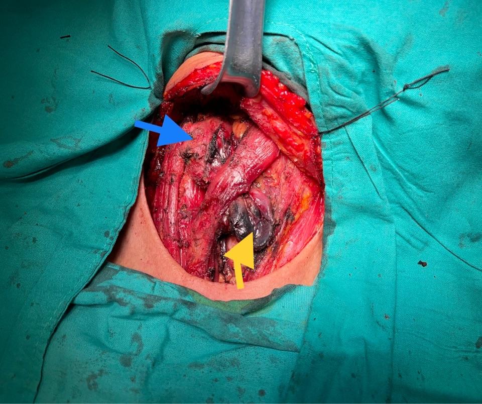 局部切除的甲状腺癌7年后局部复发并转移!