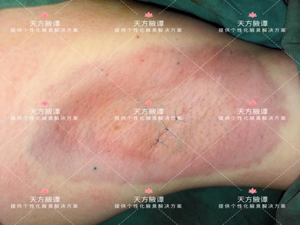 腋臭手術很嚇人嗎一千零一腋之735