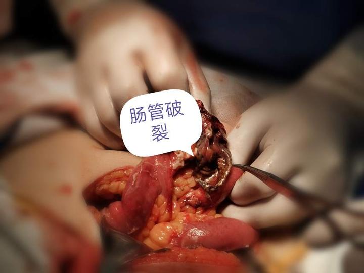 腹部闭合性损伤不容小觑