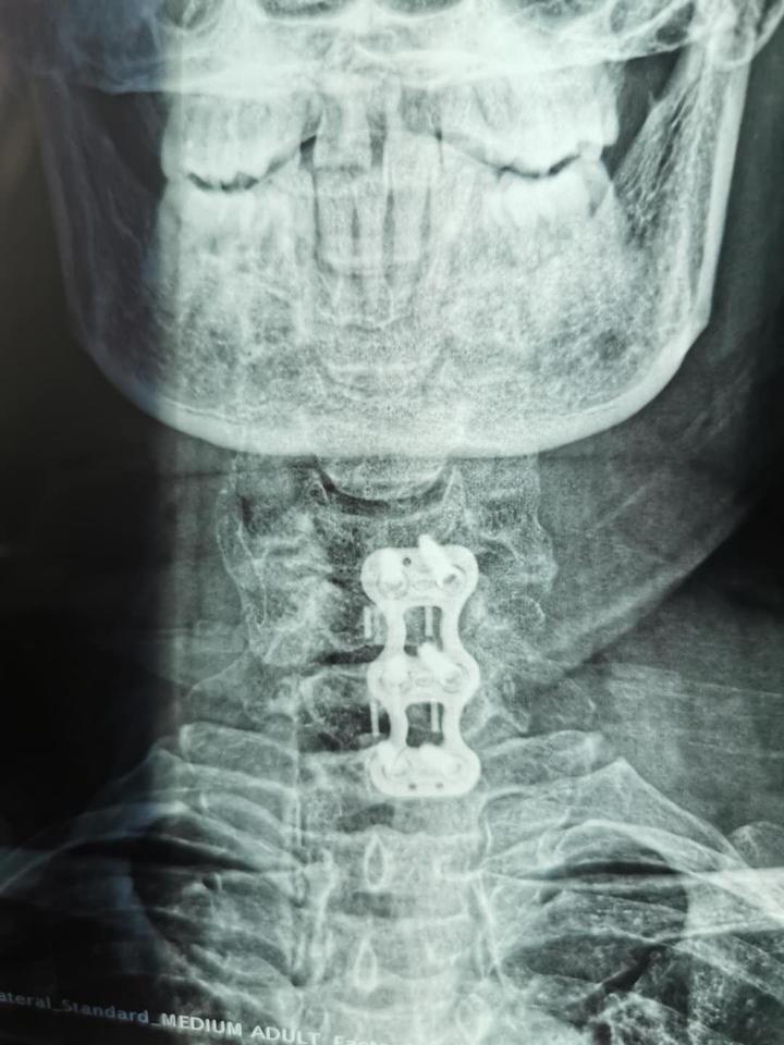 颈椎零切迹固定融合器械效果和普通钢板固定效果差不多