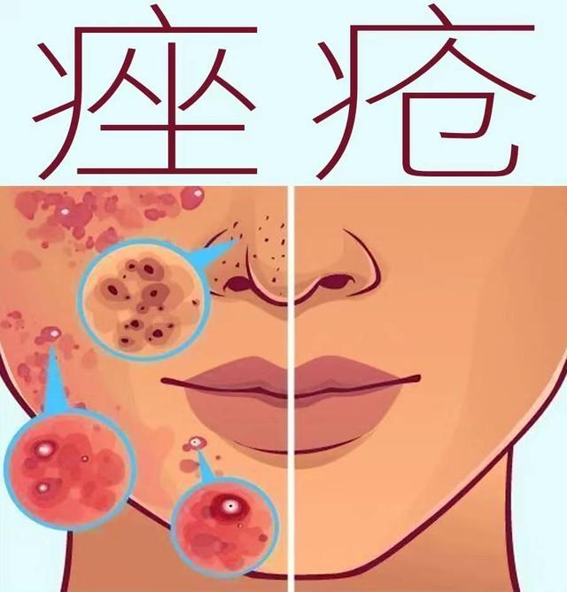 针灸击退痤疮还原属于你的美丽容颜