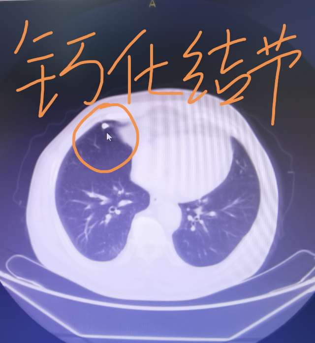 刘懿博士说肺癌(三五一二)看看肺结节完全钙化了么?是肺癌么?