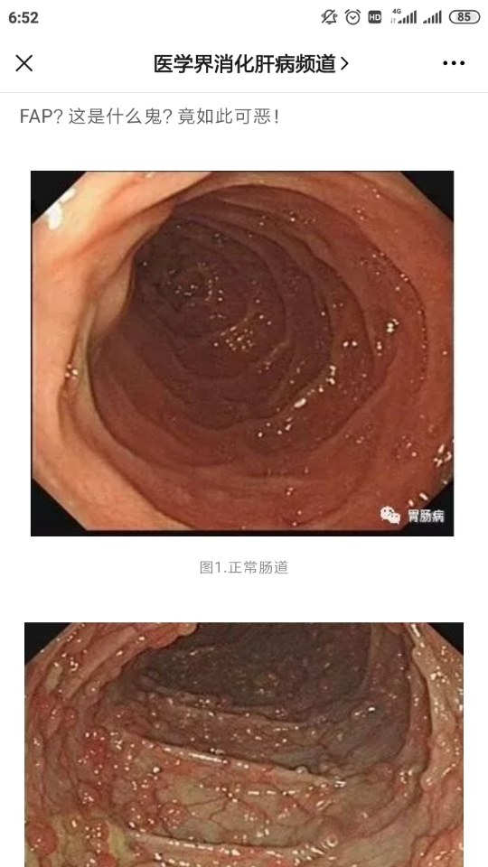 这种息肉病不但会遗传癌变率100