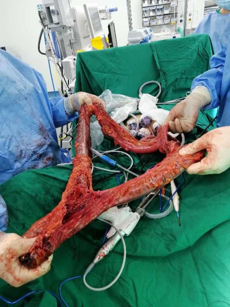 患者,女,因顽固性便秘,之前行回肠直肠吻合术,病变结肠给予了保留,术