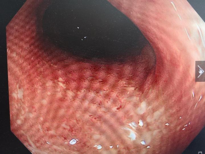 青玉散让中重度广泛结肠型溃结基本痊愈