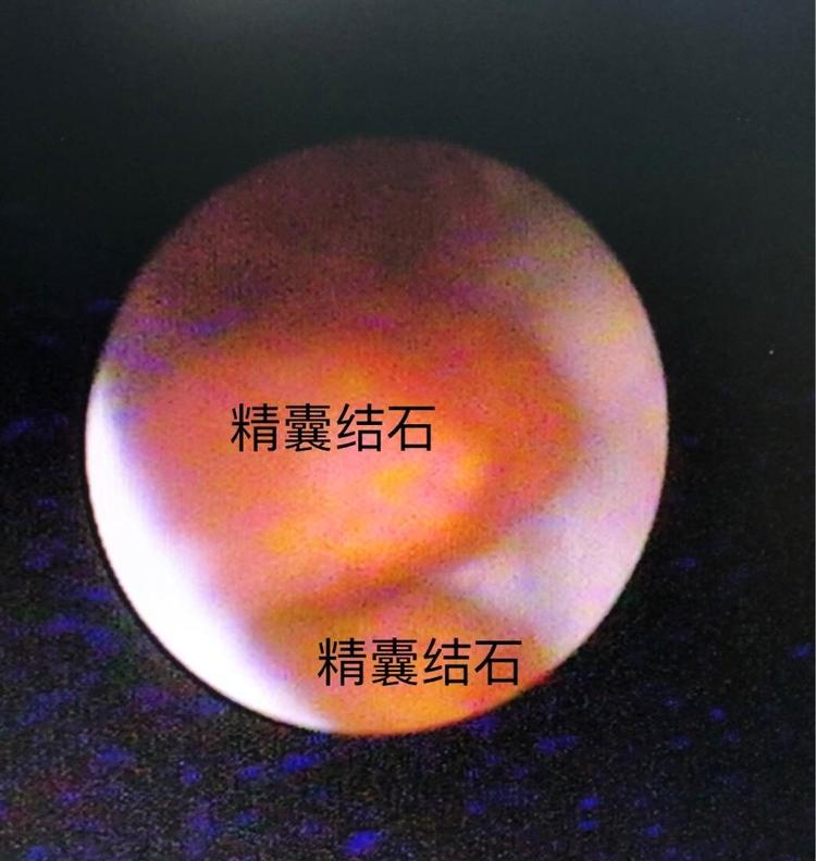 手术工作日志27:精囊炎血精,精囊结石和精囊镜手术,钬激光碎石