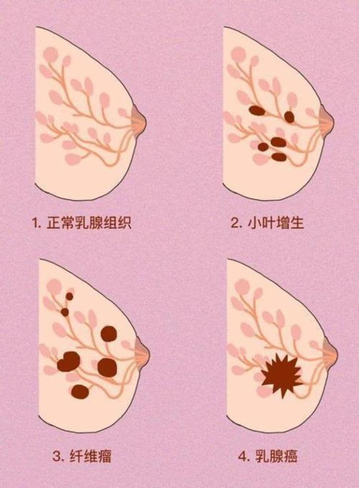 是否胸越大越容易患乳腺增生?_陈达书医生文章_无锡市妇幼保健院-微医