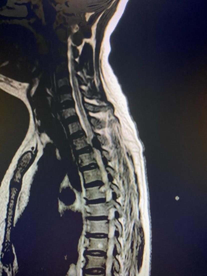 胸椎磁共振显示胸2-3平面黄韧带骨化物压迫脊髓ct显示骨化物占满整个