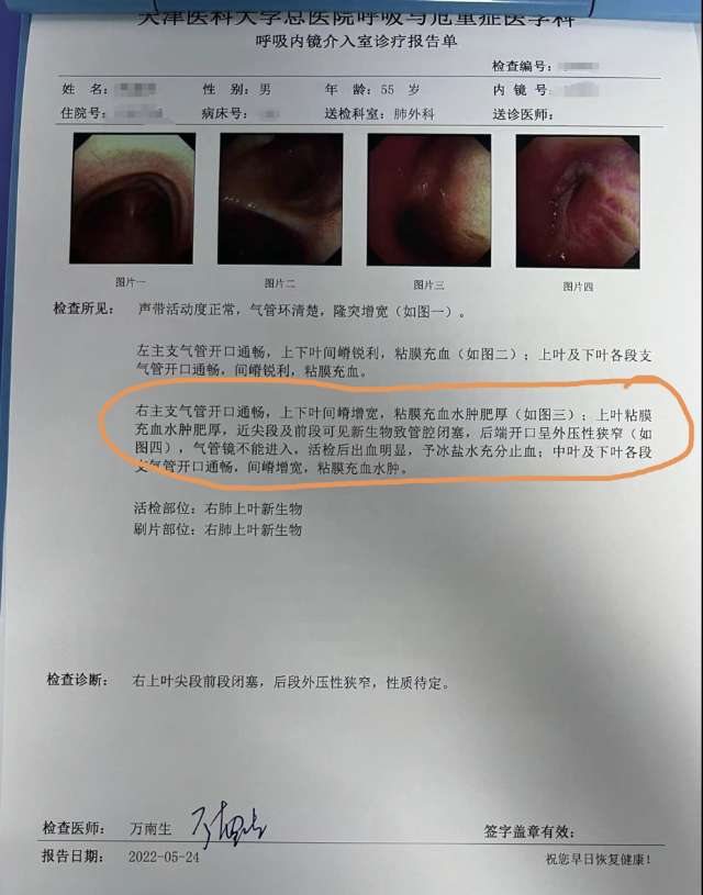 支气管镜肺癌报告图片图片