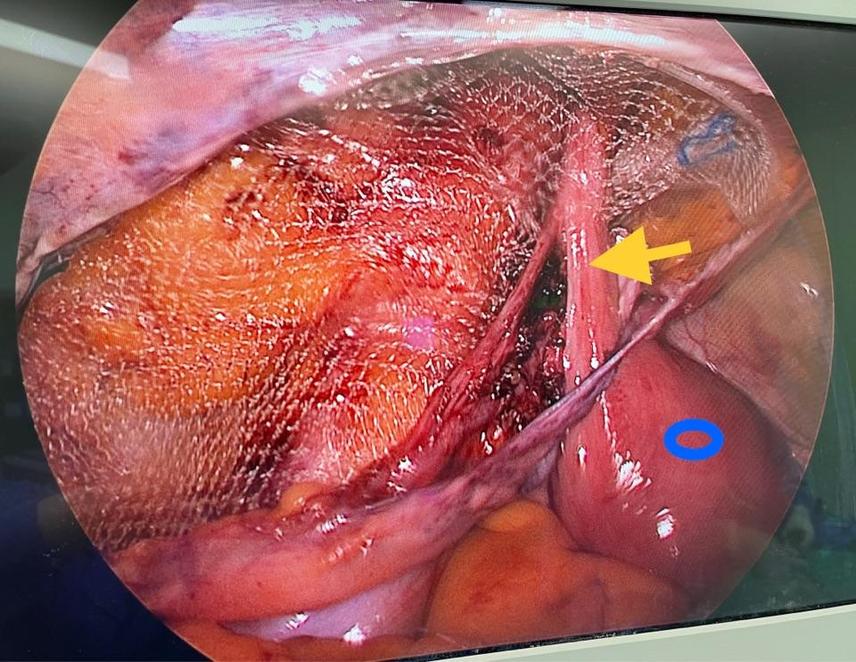 女性腹股沟疝微创手术的子宫圆韧带保护