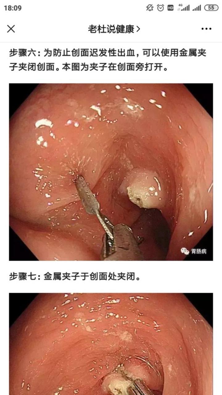 带你认识结肠息肉镜下切除术