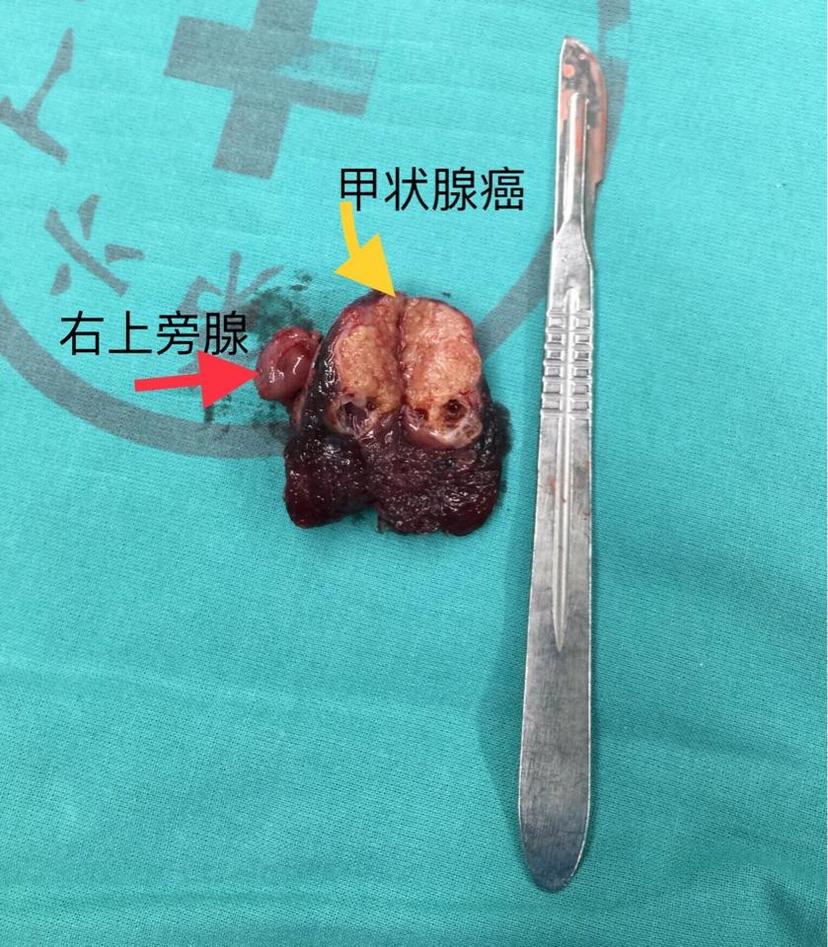 尿毒症病人并甲状腺癌侧区淋巴转移同时出现甲状旁腺功能亢进