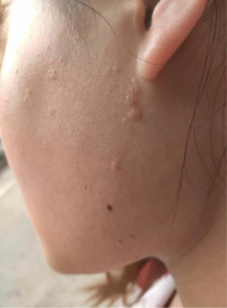 宝宝长了瘊子怎么办谈谈儿童病毒疣