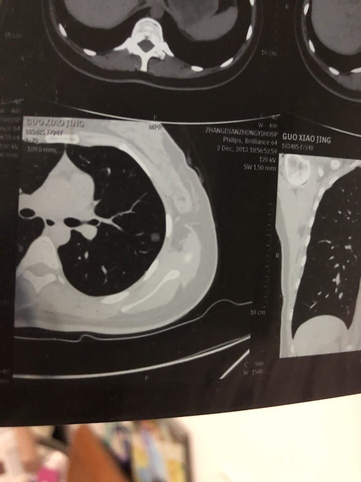 肺部磨玻璃結節影需要手術嗎