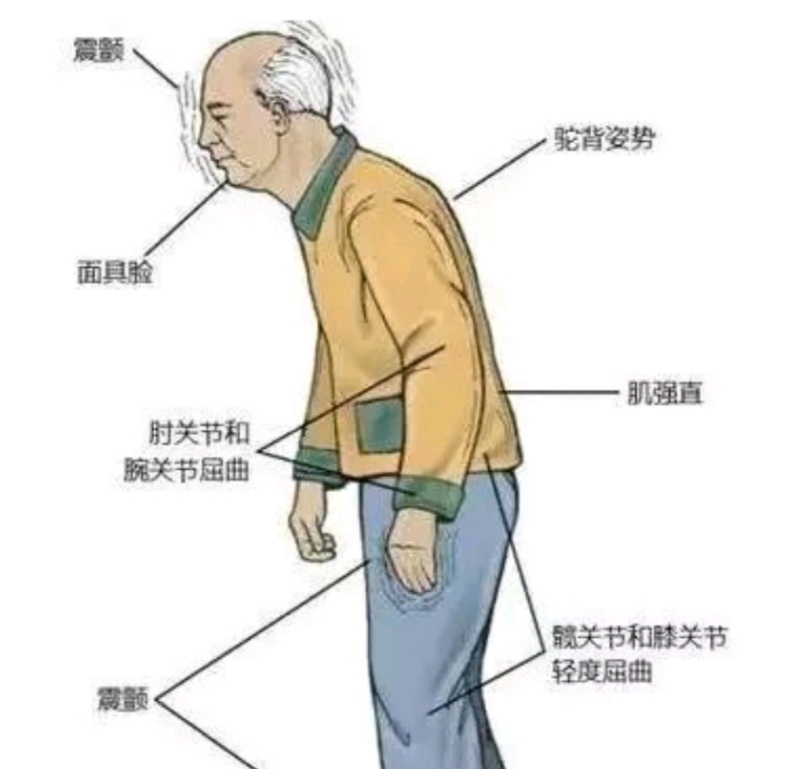 临床上主要表现为静止性震颤,运动迟缓,肌强直和姿势步态障碍