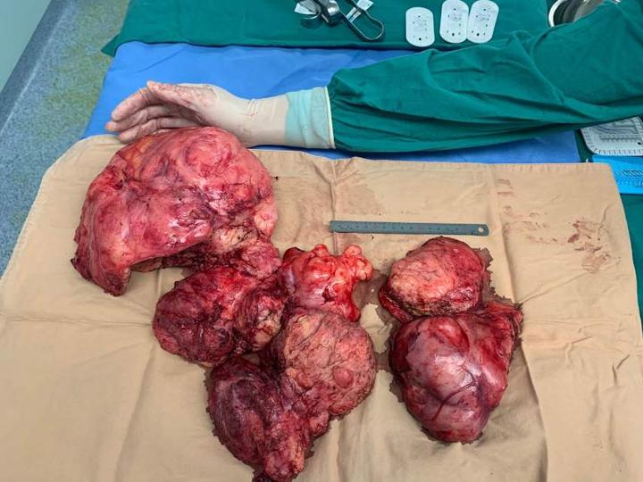 最近遇到的几例腹腔肿瘤