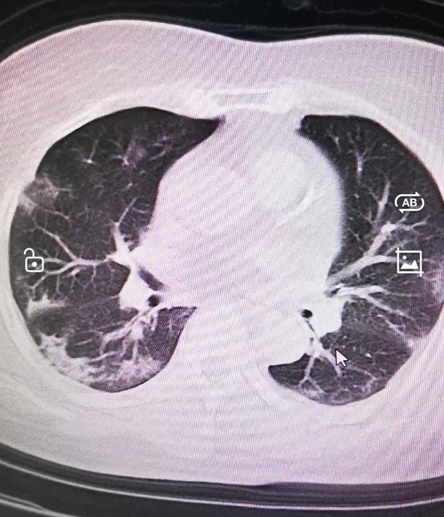 新冠肺炎病人肺部图片图片